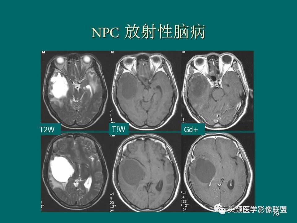 影像PPT - 【PPT】鼻咽癌的MRI诊断-79