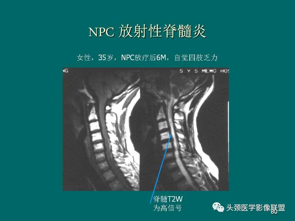 影像PPT - 【PPT】鼻咽癌的MRI诊断-80