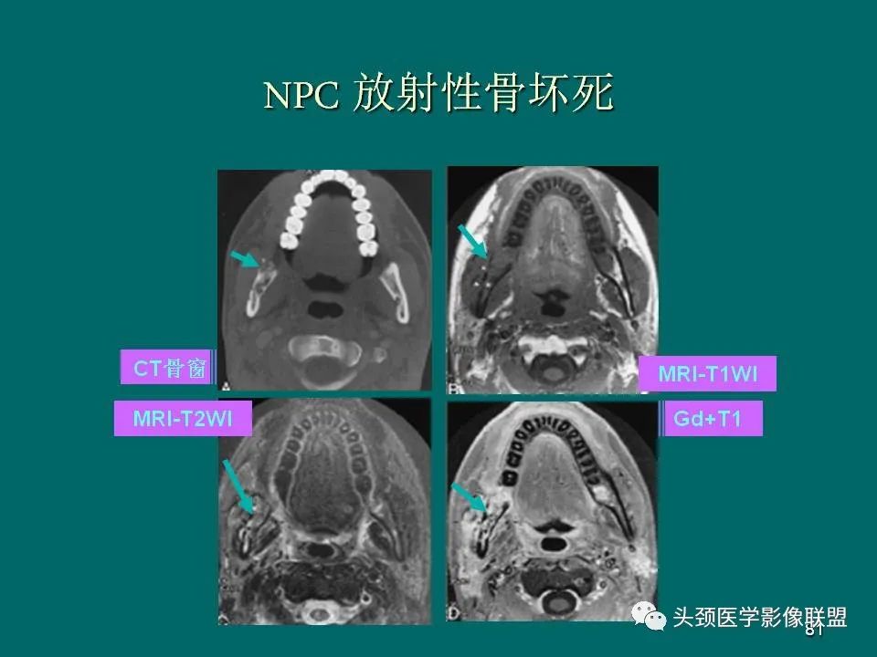 影像PPT - 【PPT】鼻咽癌的MRI诊断-81