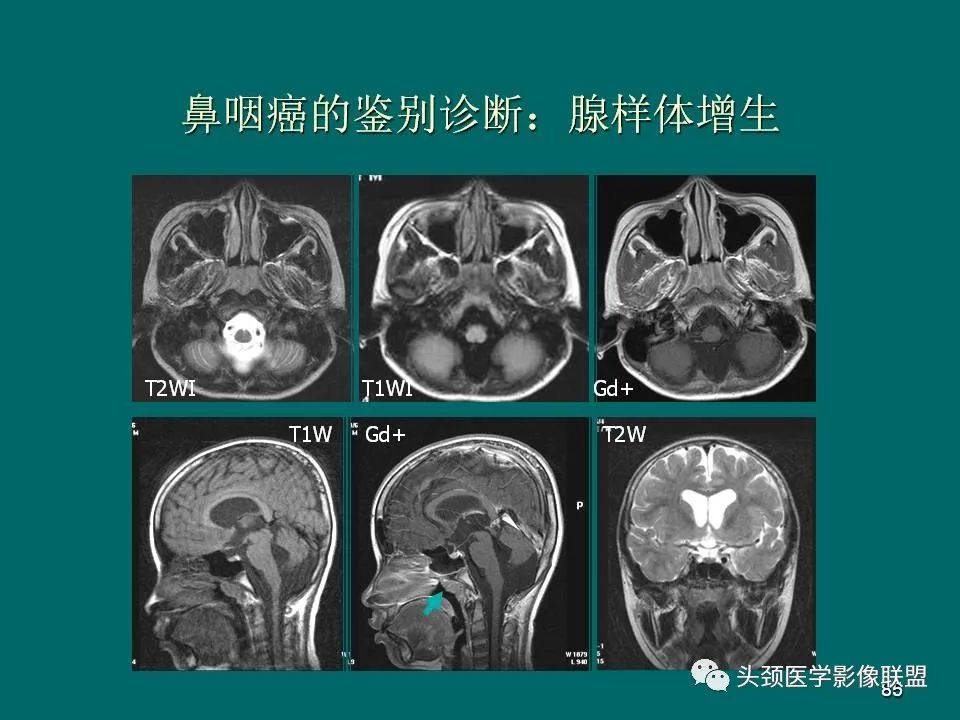 影像PPT - 【PPT】鼻咽癌的MRI诊断-85