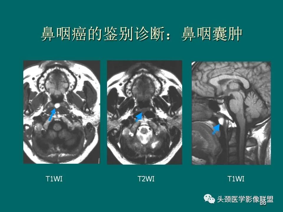 影像PPT - 【PPT】鼻咽癌的MRI诊断-86