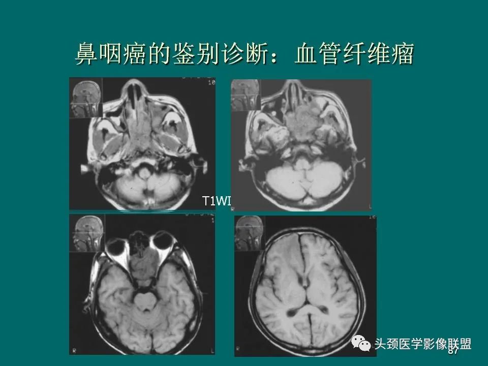 影像PPT - 【PPT】鼻咽癌的MRI诊断-87