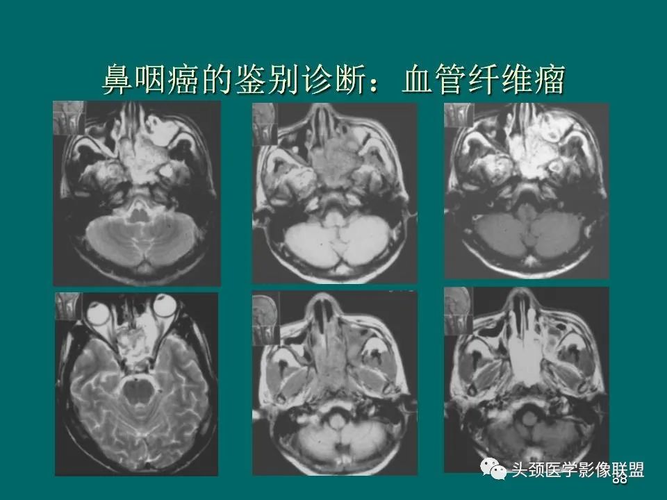 影像PPT - 【PPT】鼻咽癌的MRI诊断-88