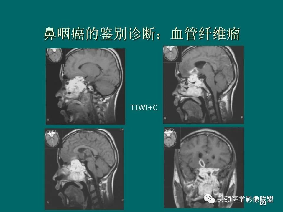 影像PPT - 【PPT】鼻咽癌的MRI诊断-89