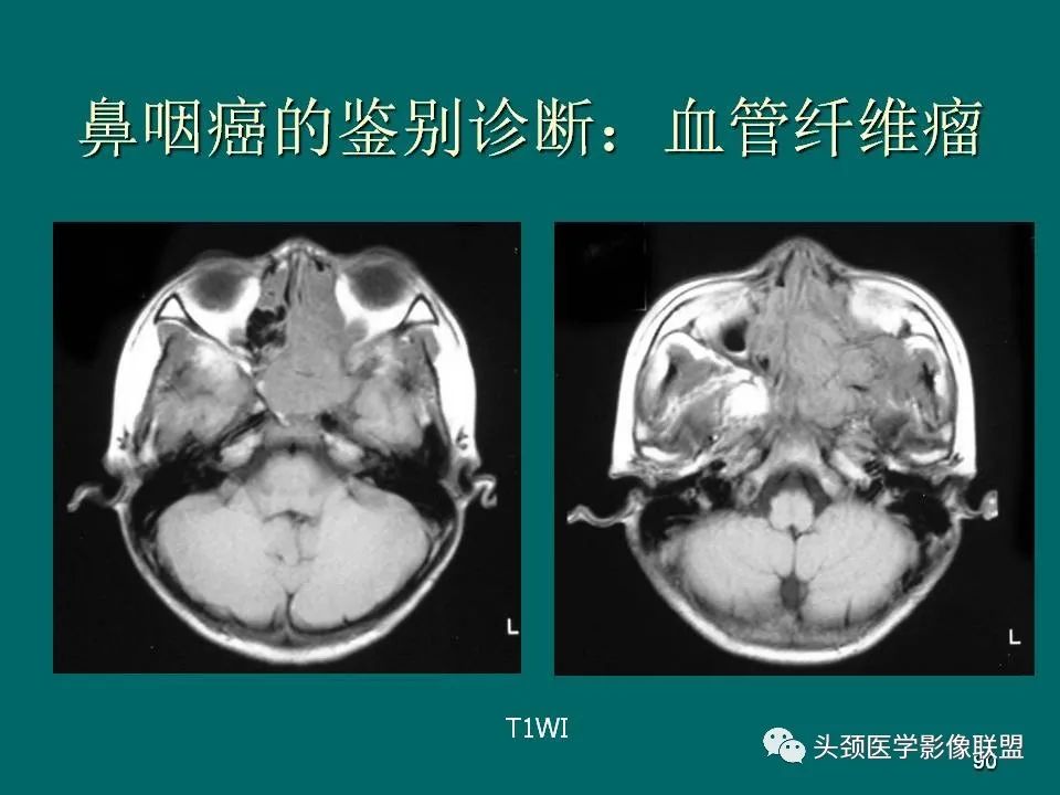 影像PPT - 【PPT】鼻咽癌的MRI诊断-90