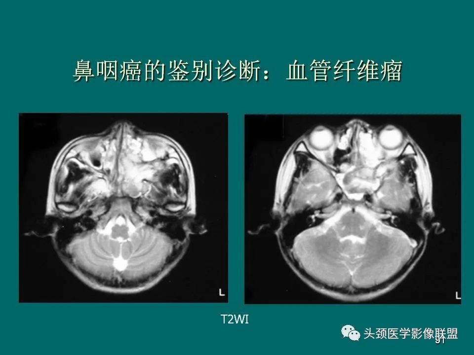 影像PPT - 【PPT】鼻咽癌的MRI诊断-91