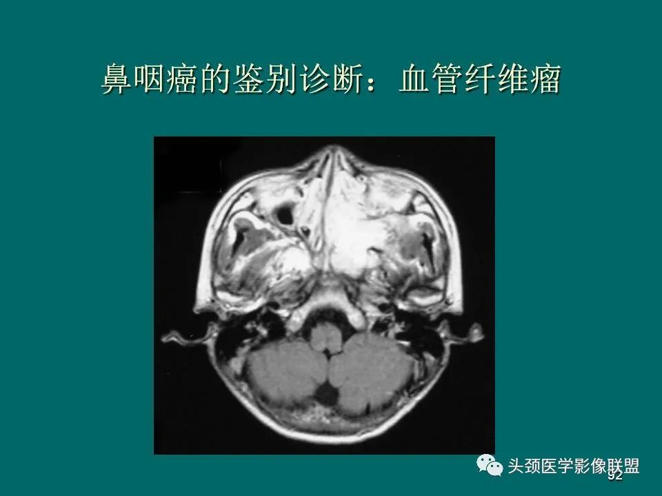 影像PPT - 【PPT】鼻咽癌的MRI诊断-92