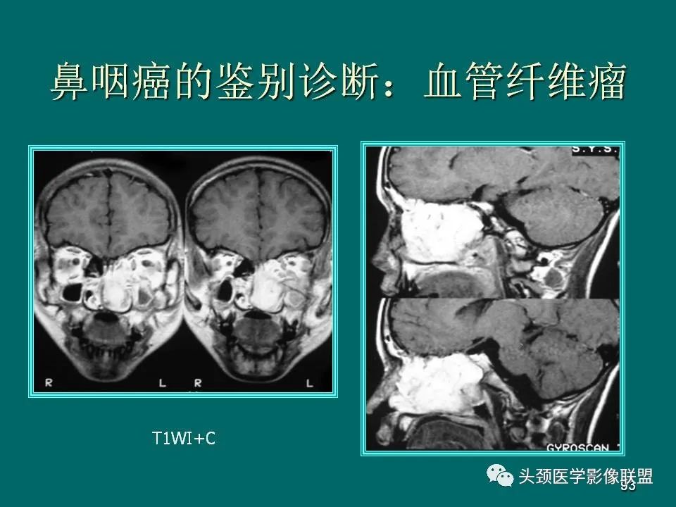 影像PPT - 【PPT】鼻咽癌的MRI诊断-93