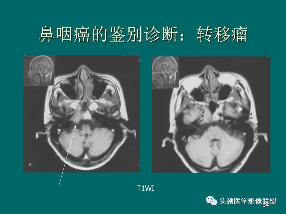 影像PPT - 【PPT】鼻咽癌的MRI诊断-94