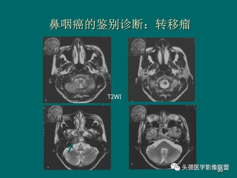 影像PPT - 【PPT】鼻咽癌的MRI诊断-95