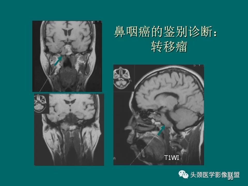影像PPT - 【PPT】鼻咽癌的MRI诊断-96