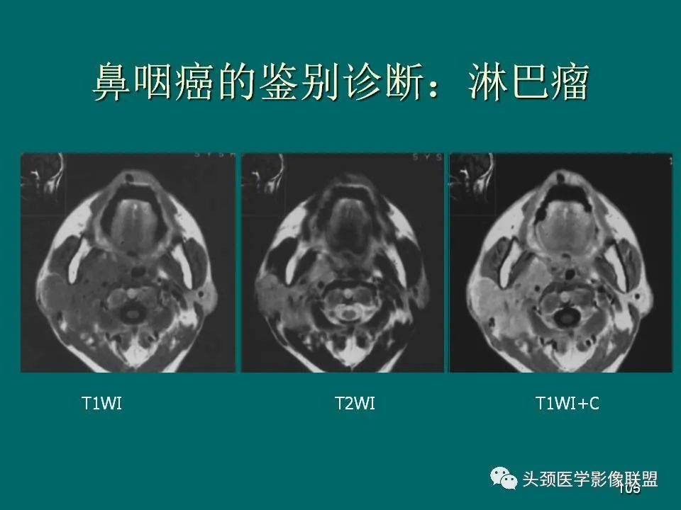 影像PPT - 【PPT】鼻咽癌的MRI诊断-105