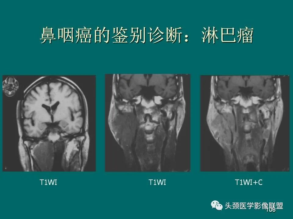 影像PPT - 【PPT】鼻咽癌的MRI诊断-106