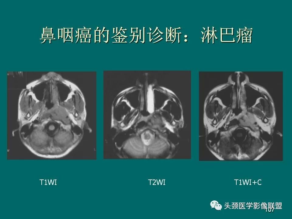 影像PPT - 【PPT】鼻咽癌的MRI诊断-107