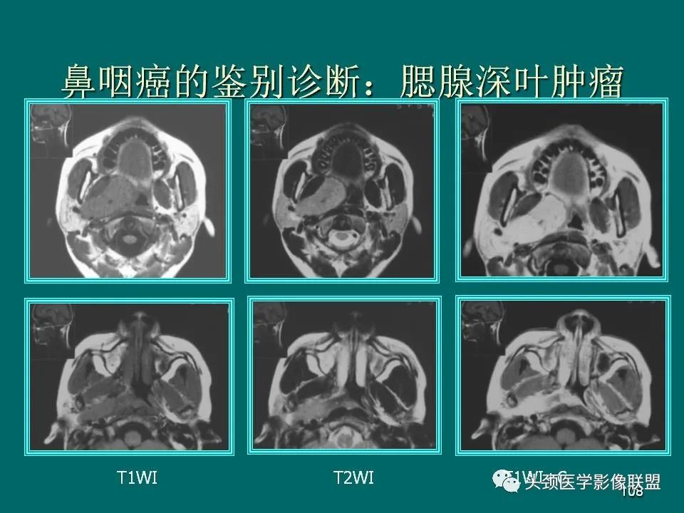 影像PPT - 【PPT】鼻咽癌的MRI诊断-108