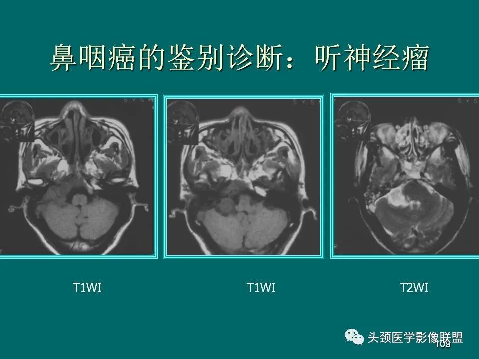 影像PPT - 【PPT】鼻咽癌的MRI诊断-109