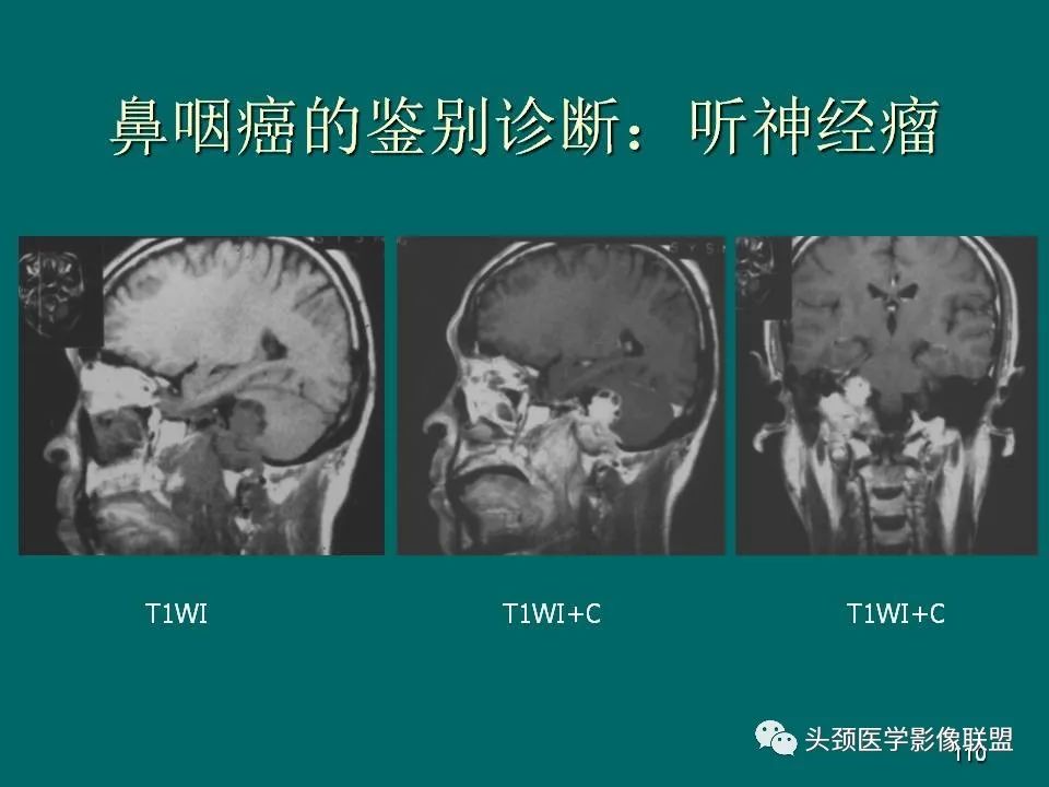 影像PPT - 【PPT】鼻咽癌的MRI诊断-110