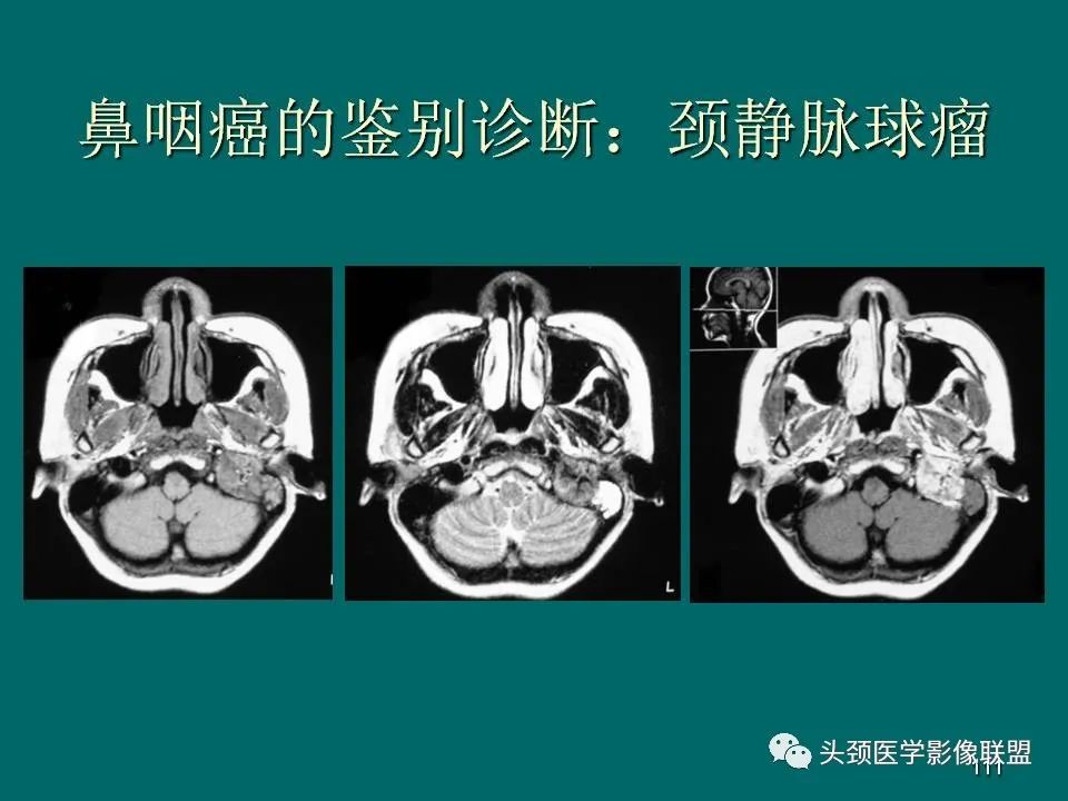 影像PPT - 【PPT】鼻咽癌的MRI诊断-111