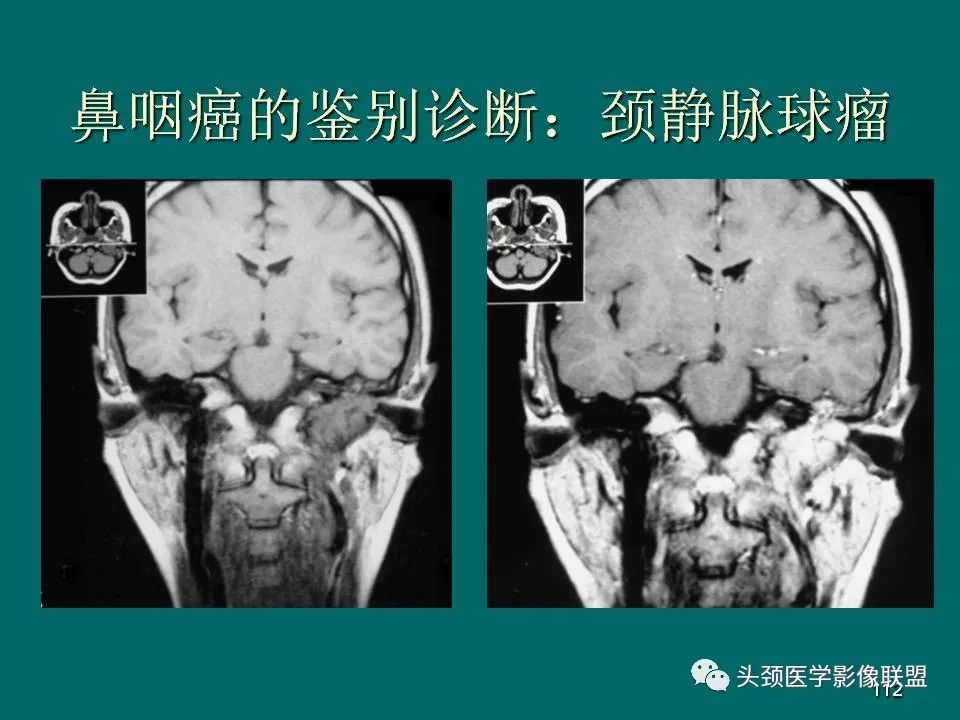 影像PPT - 【PPT】鼻咽癌的MRI诊断-112