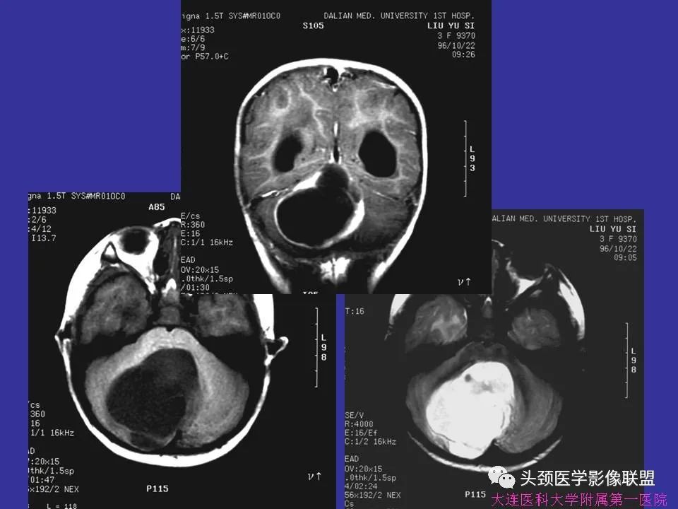 影像PPT - 【PPT】胶质瘤影像诊断及鉴别诊断-9
