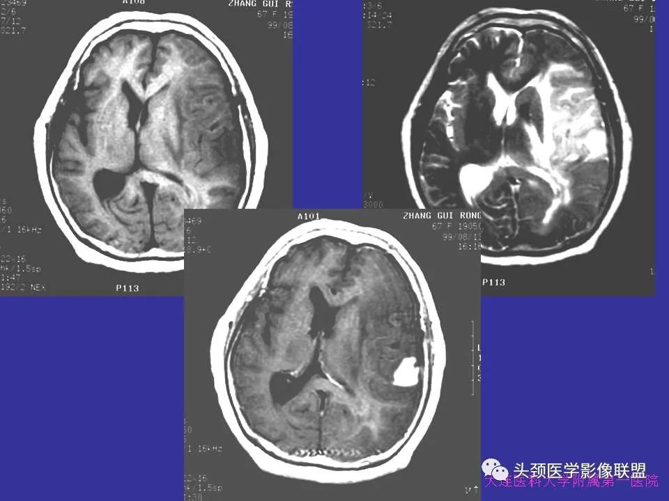 影像PPT - 【PPT】胶质瘤影像诊断及鉴别诊断-10