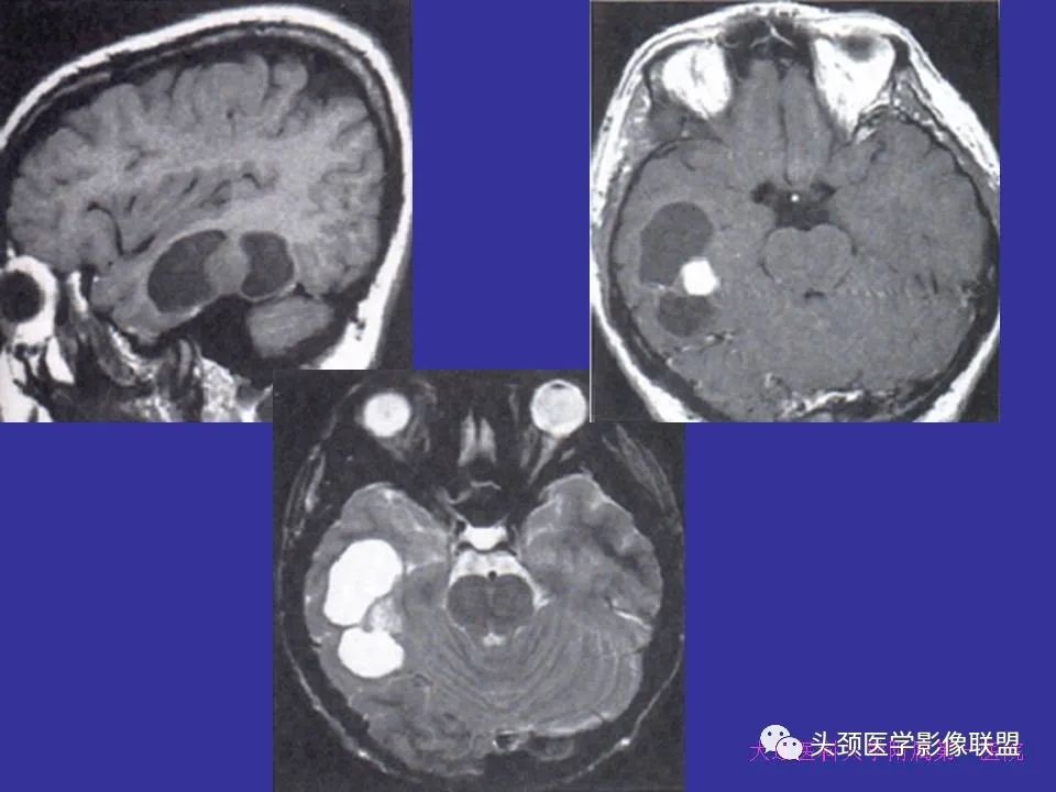 影像PPT - 【PPT】胶质瘤影像诊断及鉴别诊断-12