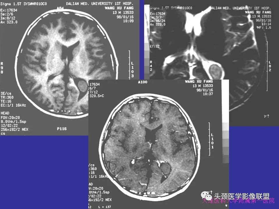 影像PPT - 【PPT】胶质瘤影像诊断及鉴别诊断-15