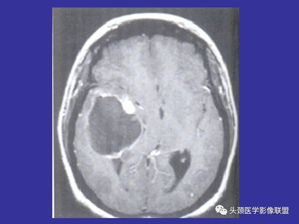 影像PPT - 【PPT】胶质瘤影像诊断及鉴别诊断-21