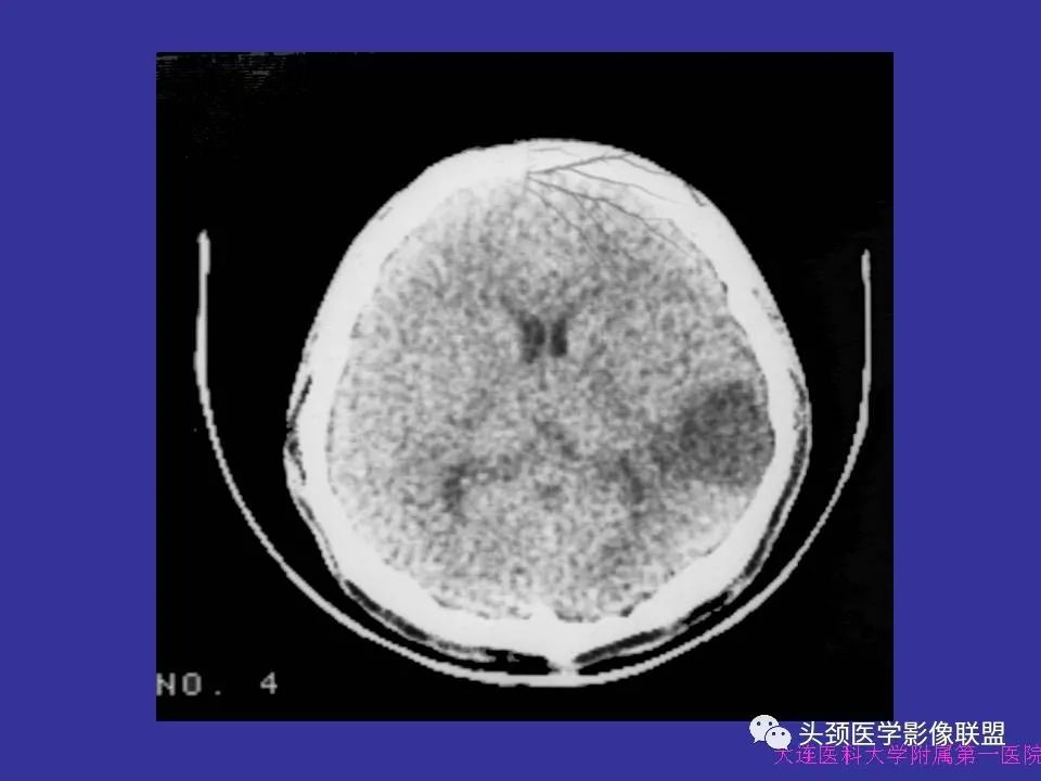 影像PPT - 【PPT】胶质瘤影像诊断及鉴别诊断-23