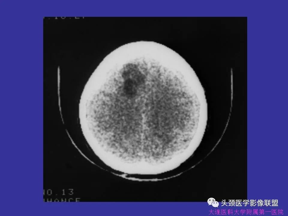 影像PPT - 【PPT】胶质瘤影像诊断及鉴别诊断-24