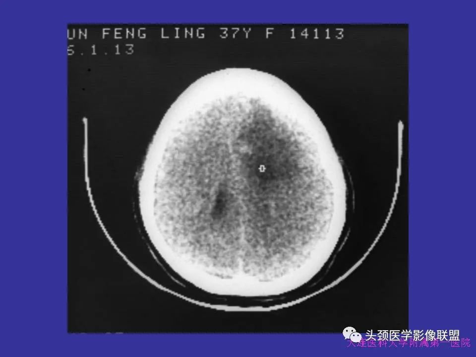 影像PPT - 【PPT】胶质瘤影像诊断及鉴别诊断-25