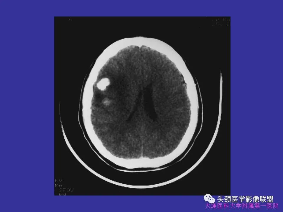 影像PPT - 【PPT】胶质瘤影像诊断及鉴别诊断-26