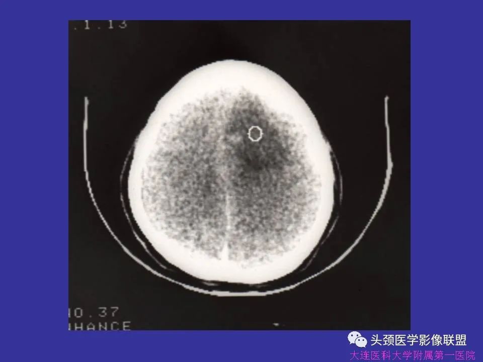 影像PPT - 【PPT】胶质瘤影像诊断及鉴别诊断-27
