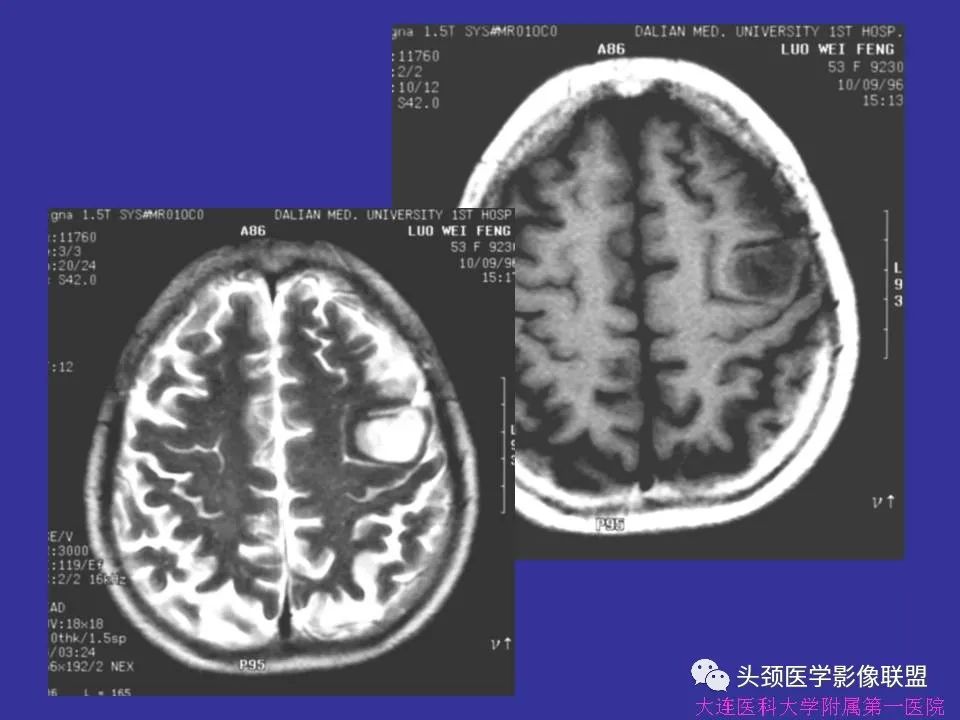 影像PPT - 【PPT】胶质瘤影像诊断及鉴别诊断-28