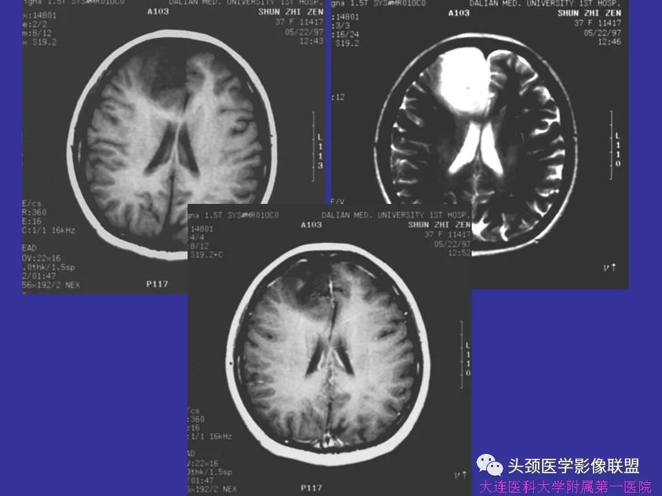 影像PPT - 【PPT】胶质瘤影像诊断及鉴别诊断-29