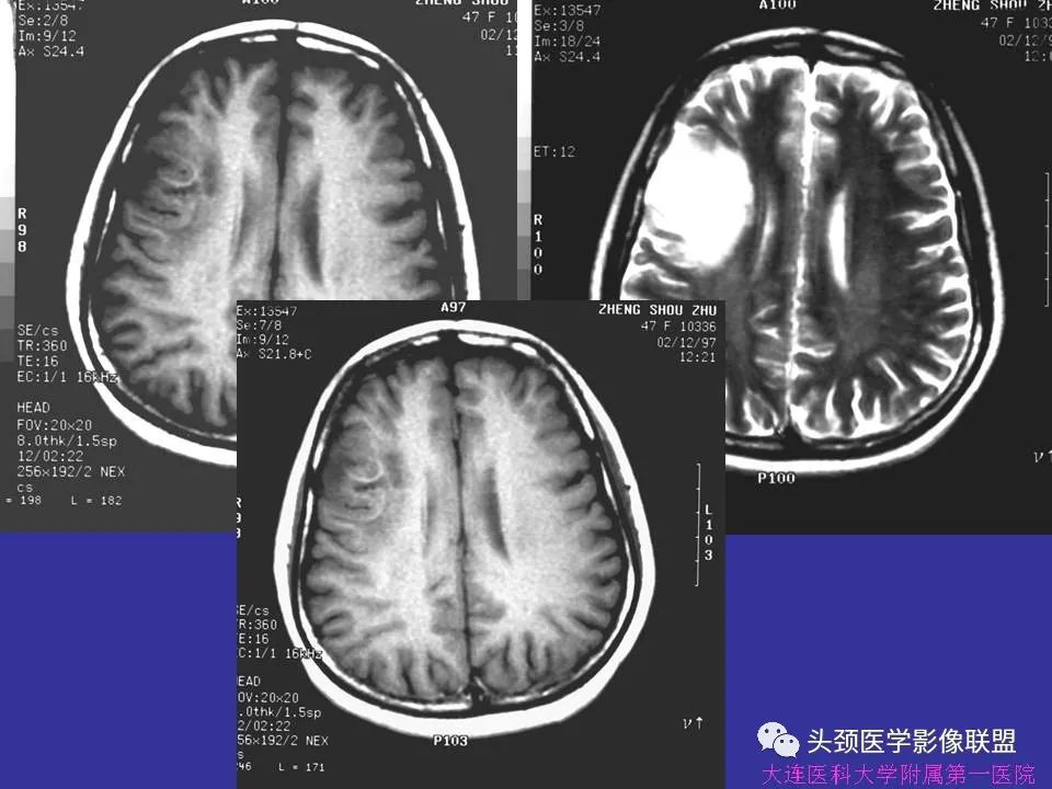 影像PPT - 【PPT】胶质瘤影像诊断及鉴别诊断-30