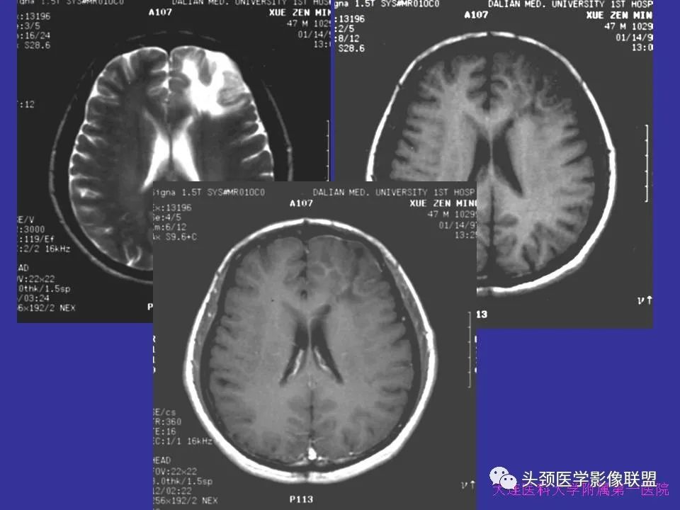 影像PPT - 【PPT】胶质瘤影像诊断及鉴别诊断-31