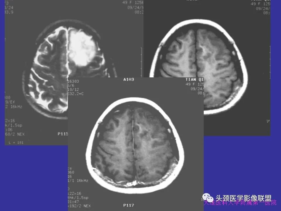 影像PPT - 【PPT】胶质瘤影像诊断及鉴别诊断-32