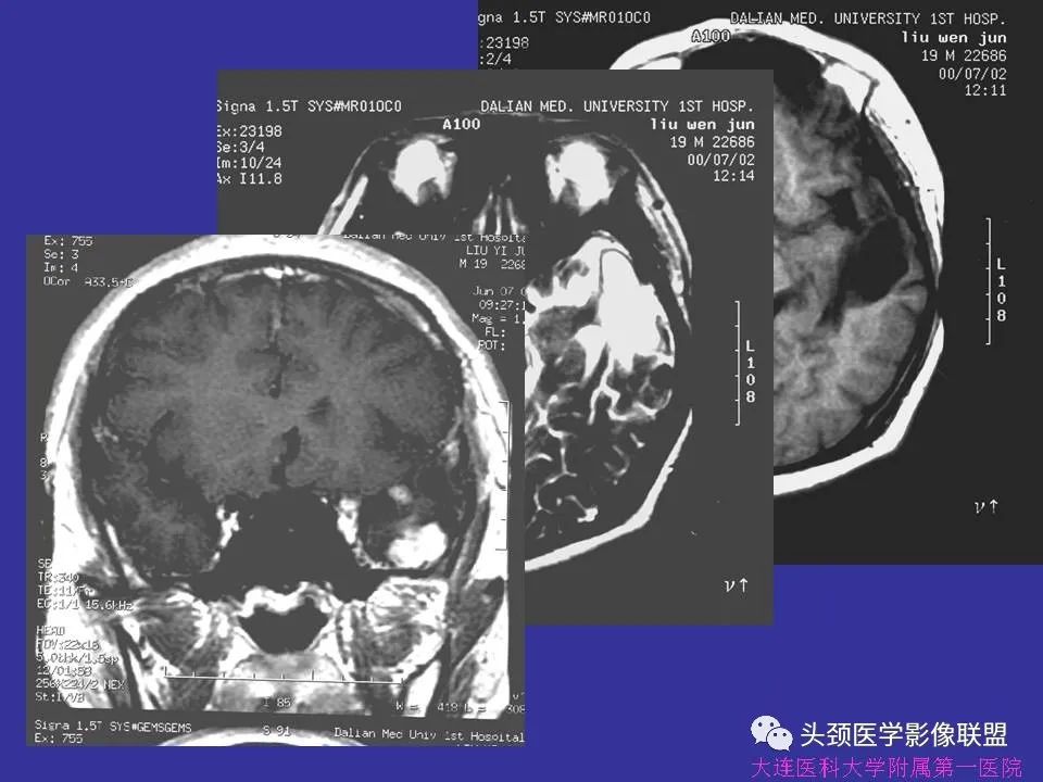 影像PPT - 【PPT】胶质瘤影像诊断及鉴别诊断-33