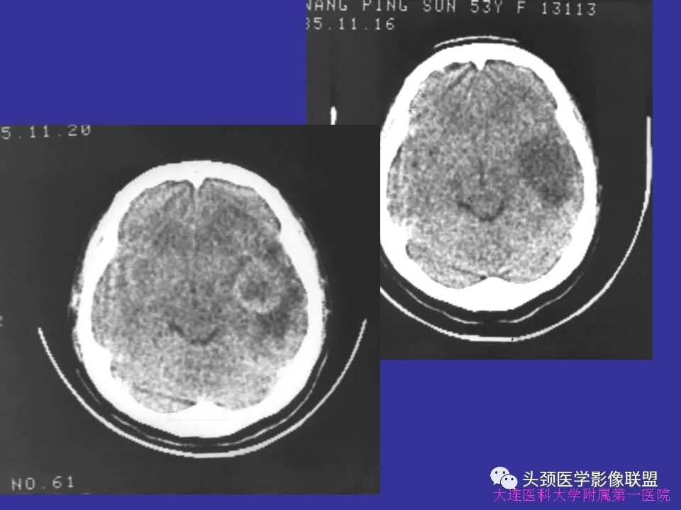 影像PPT - 【PPT】胶质瘤影像诊断及鉴别诊断-36