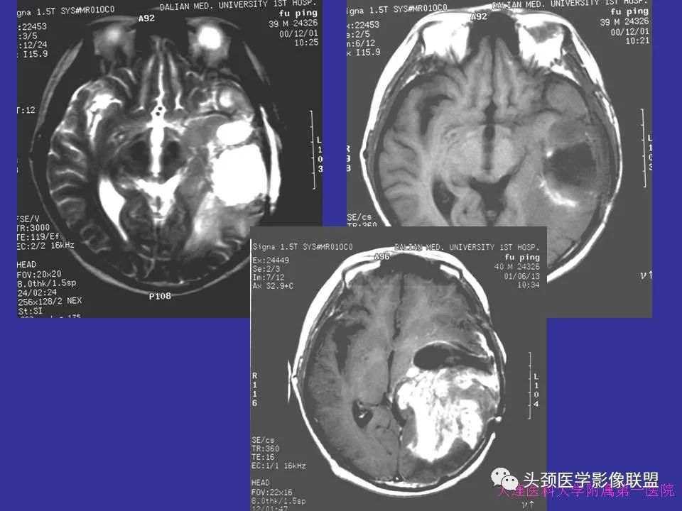 影像PPT - 【PPT】胶质瘤影像诊断及鉴别诊断-37