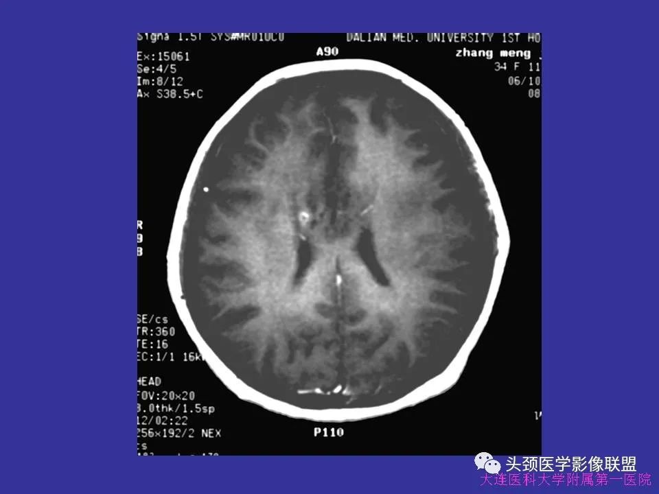 影像PPT - 【PPT】胶质瘤影像诊断及鉴别诊断-39