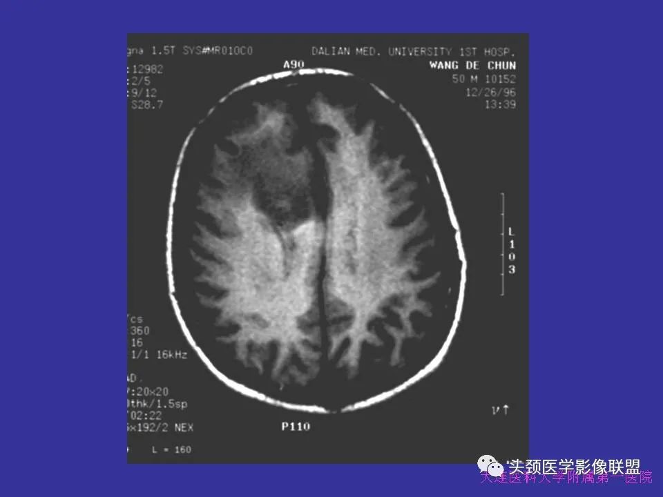 影像PPT - 【PPT】胶质瘤影像诊断及鉴别诊断-41