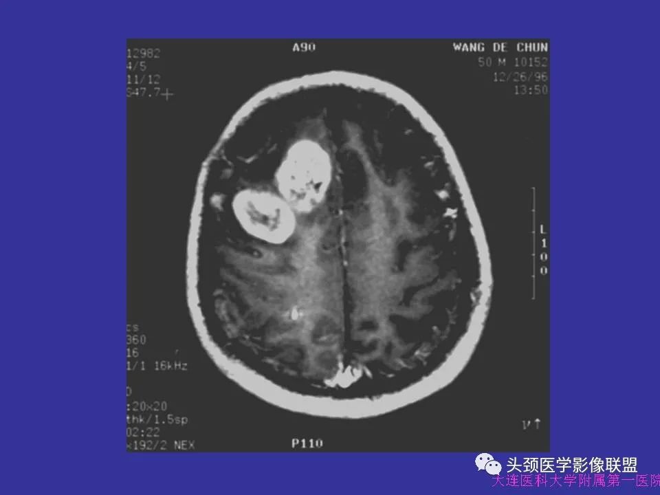 影像PPT - 【PPT】胶质瘤影像诊断及鉴别诊断-42