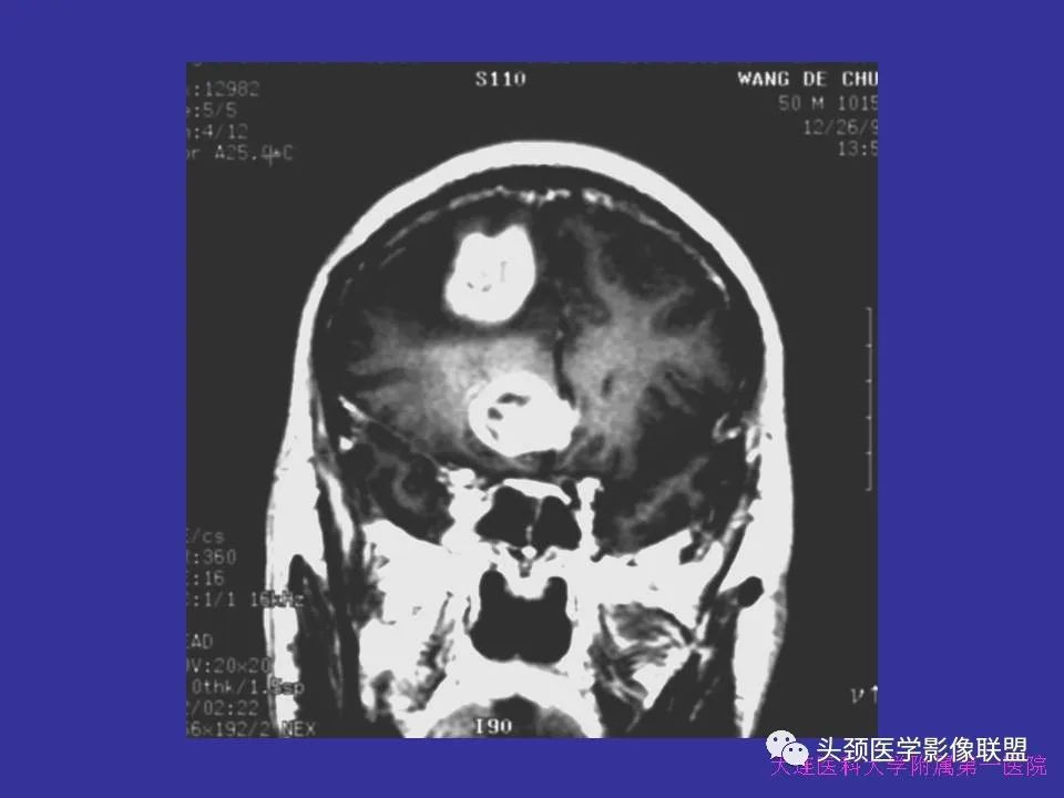 影像PPT - 【PPT】胶质瘤影像诊断及鉴别诊断-43