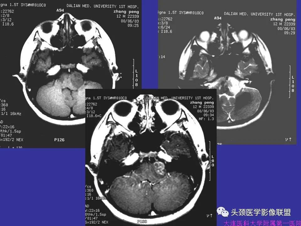 影像PPT - 【PPT】胶质瘤影像诊断及鉴别诊断-45