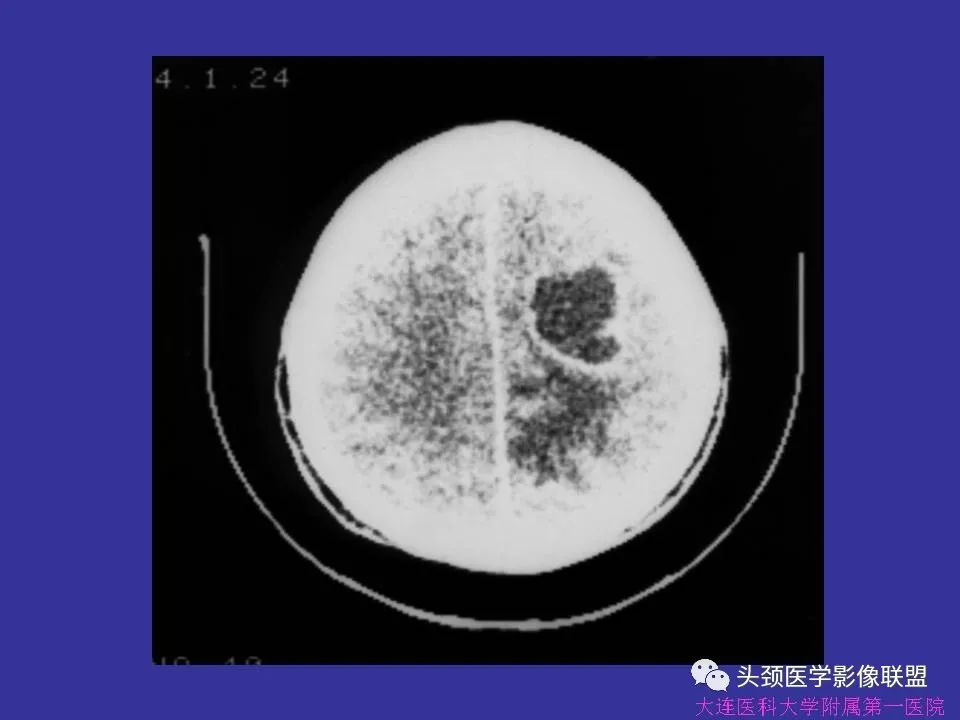 影像PPT - 【PPT】胶质瘤影像诊断及鉴别诊断-49
