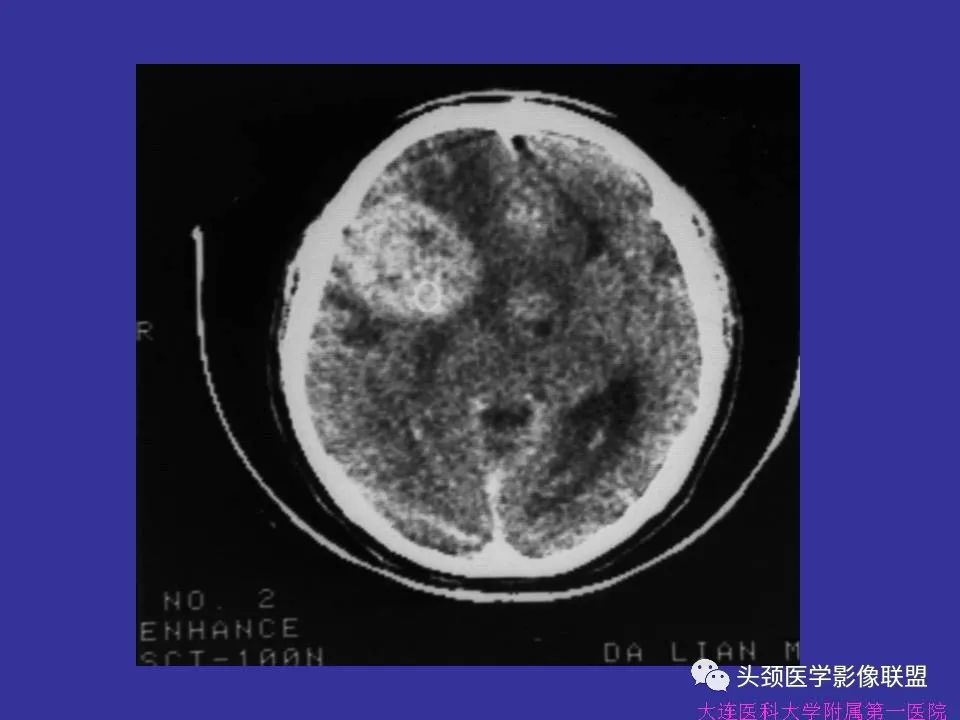 影像PPT - 【PPT】胶质瘤影像诊断及鉴别诊断-50