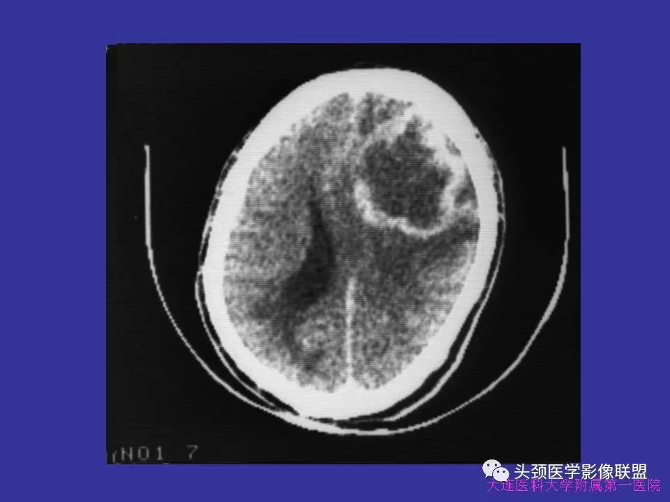 影像PPT - 【PPT】胶质瘤影像诊断及鉴别诊断-51