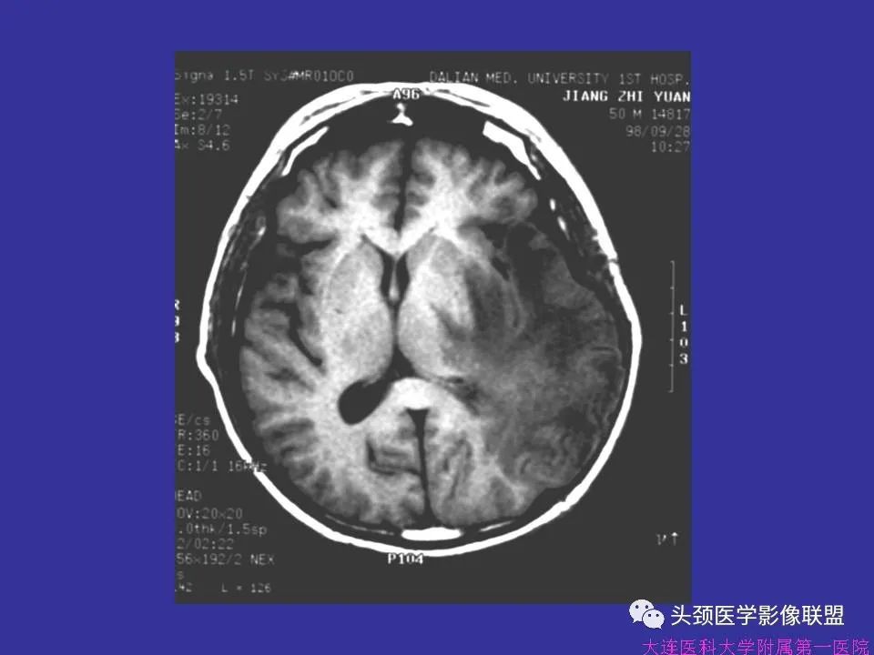影像PPT - 【PPT】胶质瘤影像诊断及鉴别诊断-52